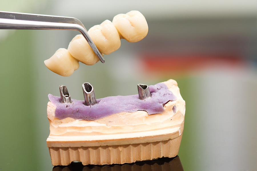 Restore Your Smile with Confidence: Everything About Getting a Dental Bridge in Houston, TX