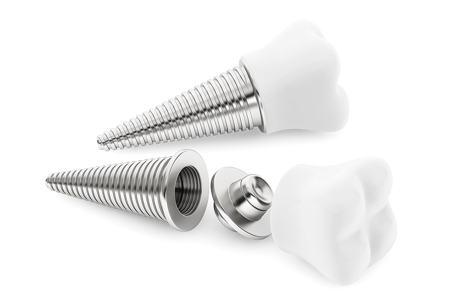 Discover the Benefits of Dental Implants: A Complete Guide for Patients in Houston, TX