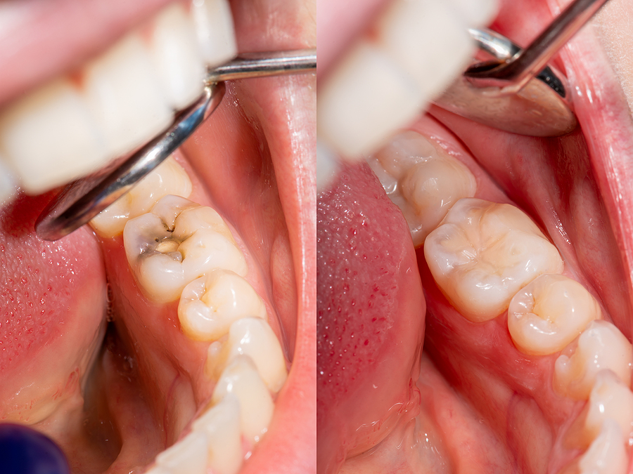 Protecting Your Smile: The Benefits of Dental Sealants in Houston, TX