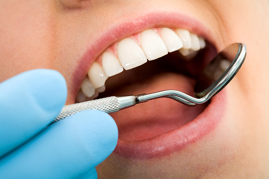 Everything You Need to Know About Fillings/Restorations in Houston, TX