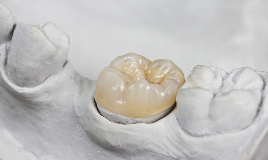Everything You Should Know About Inlays & Onlays in Houston, TX for a Stronger, Healthier Smile