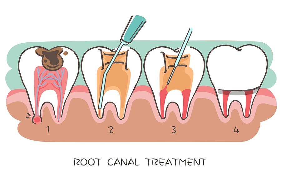 Everything You Need to Know About Root Canals: A Complete Guide for Patients in Houston, TX