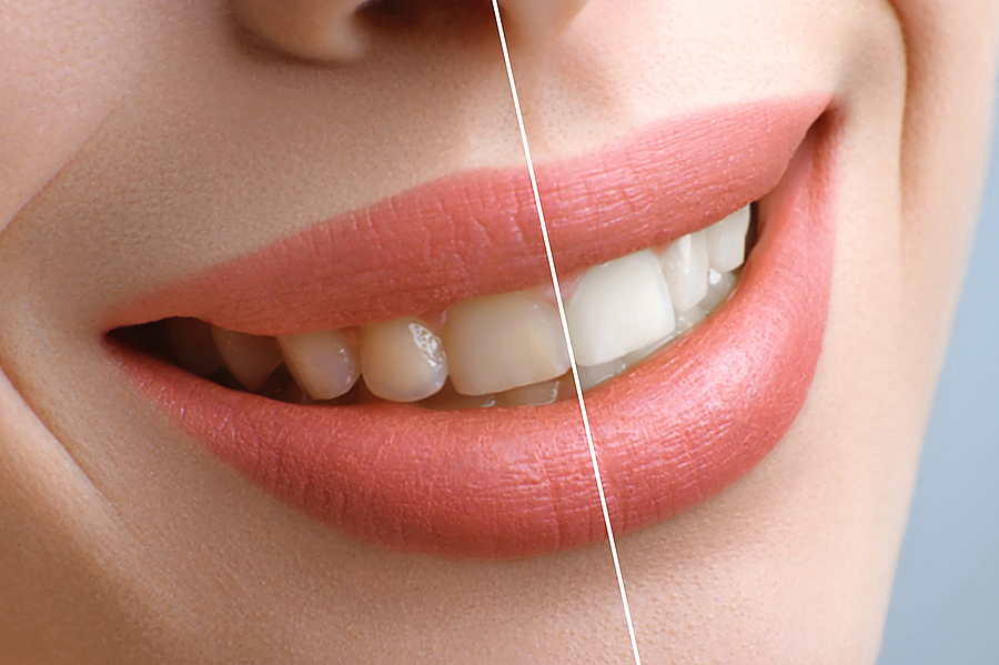 Brighten Your Smile: Everything You Need to Know About Teeth Whitening in Houston, TX