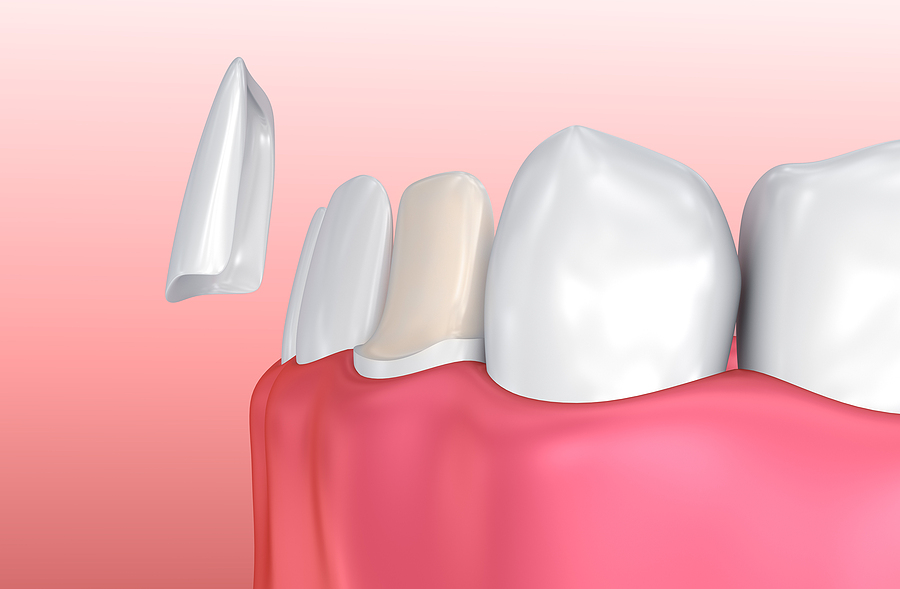 Transform Your Smile: A Complete Guide to Veneers in Houston, TX